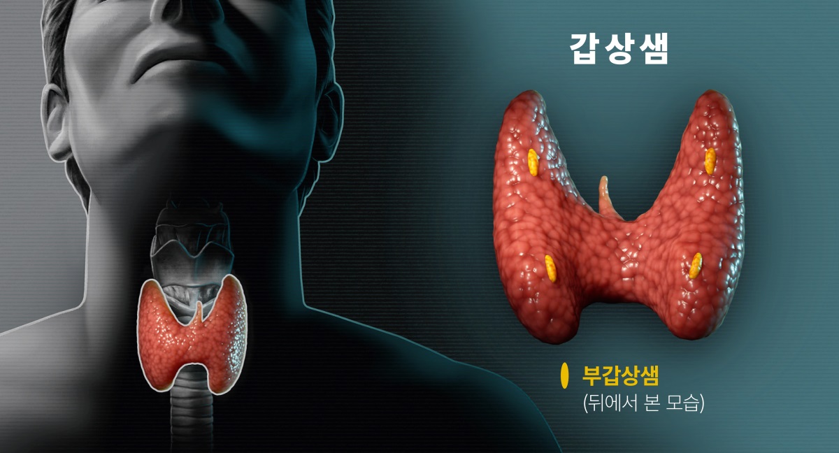 삽화 모음: 갑상샘을 보여 주는 그림. 1. 목에 있는 갑상샘의 위치를 보여 주는 그림(앞쪽에서 본 모습). 2. 갑상샘 뒷면에 있는 부갑상샘을 보여 주는 그림