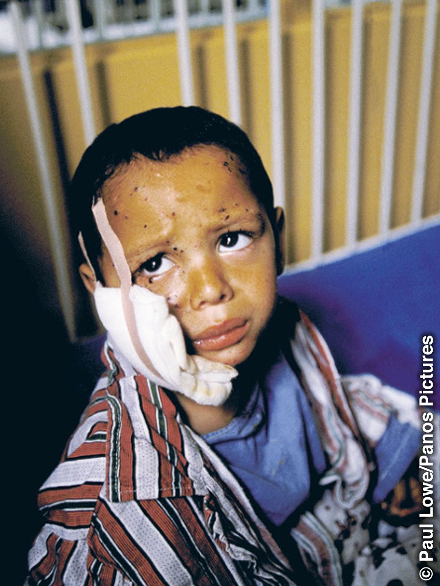 A little boy in a hospital bed with his face bandaged